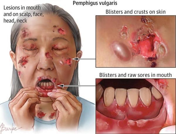 پمفیگوس چه بیماری پوستی ای است و شیوه تشخیص و درمان آن